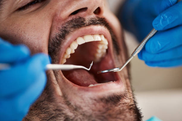 Best Emergency Tooth Extraction in Olmos Park, TX